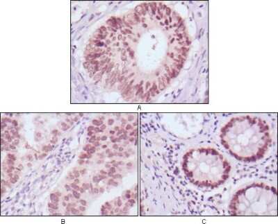 Immunohistochemistry-Paraffin: HNF-3 beta/FoxA2 Antibody (7H4B7) [NBP1-51574] - Immunohistochemical analysis of paraffin-embedded human colon cancer (A), gastric cancer (B) and rectal cancer (C) tissues using FOXA2 mouse mAb with DAB staining.
