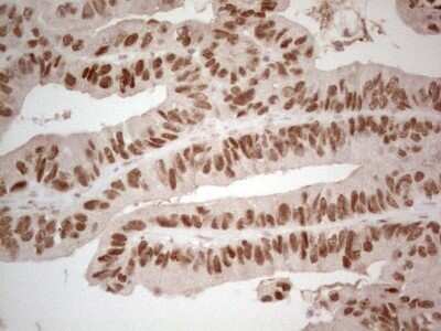 Immunohistochemistry: HNF-4 alpha/NR2A1 Antibody (OTI2H2) - Azide and BSA Free [NBP2-70905] - Analysis of Adenocarcinoma of Human colon tissue. (Heat-induced epitope retrieval by 1 mM EDTA in 10mM Tris, pH8.5, 120°C for 3min)