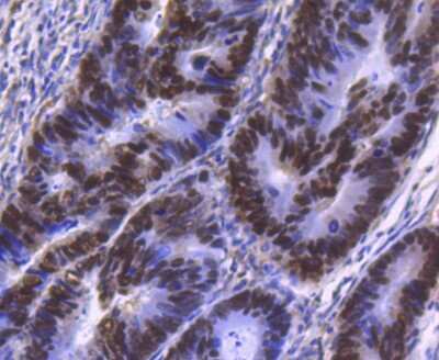 Immunohistochemistry-Paraffin: HNF-4 alpha/NR2A1 Antibody (SN72-03) [NBP2-67679] - Analysis of paraffin-embedded human colon cancer tissue using anti-HNF-4-alpha antibody. Counter stained with hematoxylin.