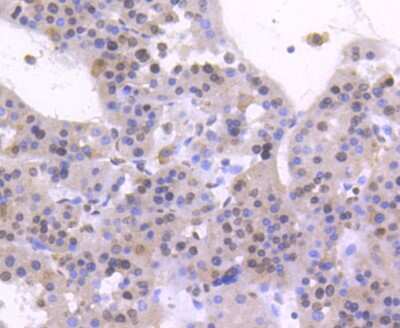 Immunohistochemistry-Paraffin: HNF-4 alpha/NR2A1 Antibody (SN72-03) [NBP2-67679] - Analysis of paraffin-embedded human liver cancer tissue using anti-HNF-4-alpha antibody. Counter stained with hematoxylin.