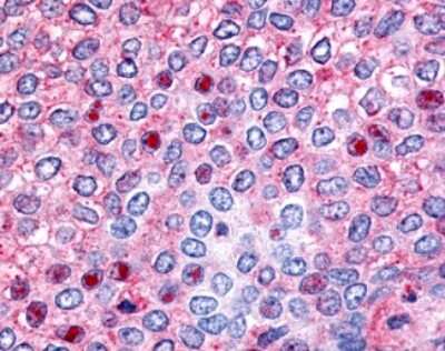 Immunohistochemistry-Paraffin: HNF-4 gamma/NR2A2 Antibody [NLS5160] - Analysis of anti-HNF4G / HNF4 Gamma antibody with human breast, carcinoma.