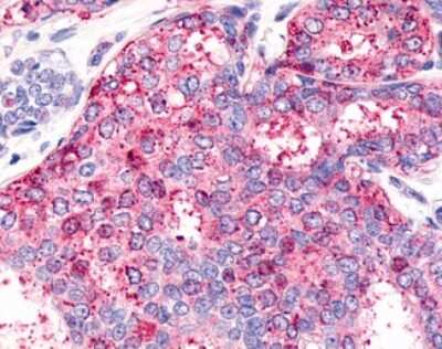 Immunohistochemistry-Paraffin: HNF-4 gamma/NR2A2 Antibody [NLS5162] - Analysis of anti-HNF4G / HNF4 Gamma antibody with human breast, carcinoma.