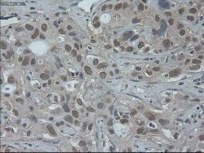 Immunohistochemistry: HNF-6/ONECUT1 Antibody (OTI4F12) - Azide and BSA Free [NBP2-70906] - Staining of paraffin-embedded Carcinoma of Human liver tissue using anti-HNF6 mouse monoclonal antibody.