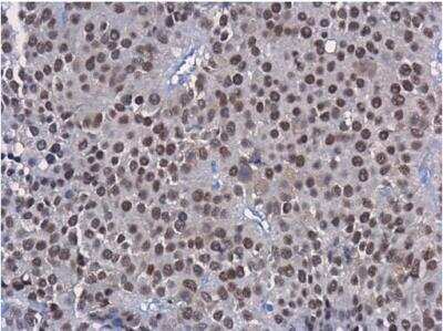 Immunohistochemistry-Paraffin: HNF1 Antibody (4110) [NBP2-43652] - Sample: Paraffin-embedded human SW480. HNF1 alpha antibody (4110) diluted at 1:250.