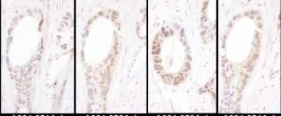 <b>Independent Antibodies Validation. </b>Immunohistochemistry: HNF1 Antibody [NBP2-32123] - Samples: FFPE serial sections of human ovarian carcinoma. Antibody: Affinity purified rabbit anti- HNF1-alpha used at a dilution of 1:5,000 (0.2ug/ml). Detection: DAB. Counterstain: Hematoxylin (blue).