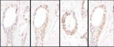 <b>Independent Antibodies Validation. </b>Immunohistochemistry: HNF1 Antibody [NBP2-32124] - Samples: FFPE serial sections of human ovarian carcinoma. Antibody: Affinity purified rabbit anti- HNF1-alpha used at a dilution of 1:5,000 (0.2ug/ml). Detection: DAB. Counterstain: Hematoxylin (blue).