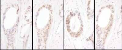 Immunohistochemistry: HNF1 Antibody [NBP2-32125] - Samples: FFPE serial sections of human ovarian carcinoma. Antibody: Affinity purified rabbit anti- HNF1-alpha used at a dilution of 1:5,000 (0.2ug/ml). Detection: DAB. Counterstain: Hematoxylin (blue).