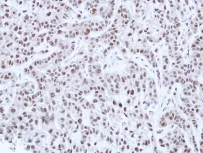 Immunohistochemistry-Paraffin: HNF1 Antibody [NBP1-33596] - Paraffin-embedded A549 Xenograft, using antibody at 1:100 dilution.