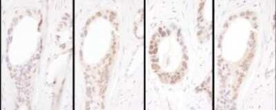 Immunohistochemistry-Paraffin: HNF1 Antibody [NBP2-32126] - Serial sections of human ovarian carcinoma. Antibody: Affinity purified rabbit anti- HNF1-alpha used at a dilution of 1:5,000 (0.2ug/ml). Detection: DAB. Counterstain: Hematoxylin (blue).