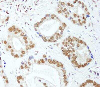 <b>Independent Antibodies Validation and Biological Strategies Validation.</b>Immunohistochemistry-Paraffin: HNRNPUL1 Antibody [NB110-40587] - Human prostate carcinoma.  Antibody used at a dilution of 1:200.