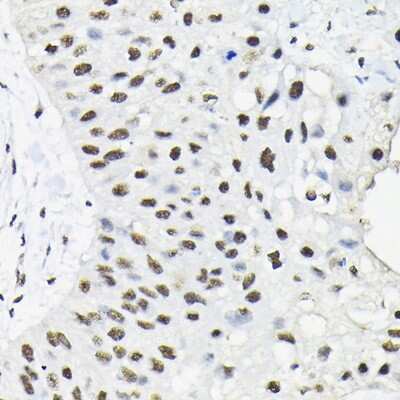 Immunohistochemistry-Paraffin: HNRPA3 Antibody [NBP3-15982] - Immunohistochemistry of paraffin-embedded human lung cancer using HNRPA3 Rabbit pAb (NBP3-15982) at dilution of 1:100 (40x lens).Perform high pressure antigen retrieval with 10 mM citrate buffer pH 6.0 before commencing with IHC staining protocol.