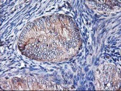 Immunohistochemistry: HO-2/HMOX2 Antibody (OTI1C2) - Azide and BSA Free [NBP2-70895] - Staining of paraffin-embedded Adenocarcinoma of Human endometrium tissue using anti-Heme oxygenase 2 mouse monoclonal antibody.