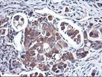 Immunohistochemistry: HO-2/HMOX2 Antibody (OTI1C2) - Azide and BSA Free [NBP2-70895] - Staining of paraffin-embedded Carcinoma of Human lung tissue using anti-Heme oxygenase 2 mouse monoclonal antibody.