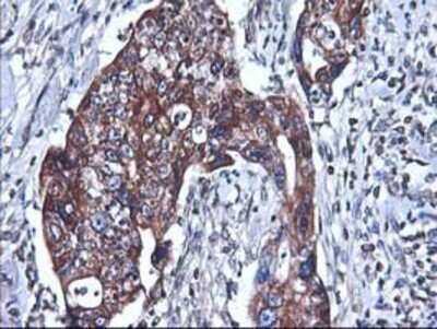 Immunohistochemistry: HO-2/HMOX2 Antibody (OTI1C2) - Azide and BSA Free [NBP2-70895] - Staining of paraffin-embedded Carcinoma of Human pancreas tissue using anti-Heme oxygenase 2 mouse monoclonal antibody.