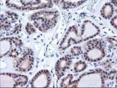 Immunohistochemistry: HO-2/HMOX2 Antibody (OTI1C2) - Azide and BSA Free [NBP2-70895] - Staining of paraffin-embedded Carcinoma of Human thyroid tissue using anti-Heme oxygenase 2 mouse monoclonal antibody.
