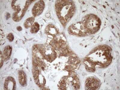 Immunohistochemistry: HOXC10 Antibody (5C10) [NBP2-46000] - Analysis of Adenocarcinoma of Human breast tissue. (Heat-induced epitope retrieval by 1mM EDTA in 10mM Tris buffer (pH8.5) at 120C for 3 min)(1:150)