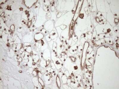 Immunohistochemistry: HOXC10 Antibody (5C10) [NBP2-46000] - Analysis of Carcinoma of Human kidney tissue. (Heat-induced epitope retrieval by 1mM EDTA in 10mM Tris buffer (pH8.5) at 120C for 3 min)(1:150)