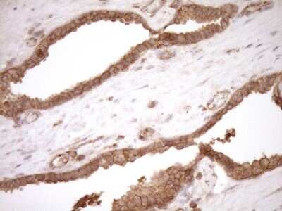 Immunohistochemistry: HOXC10 Antibody (5C10) [NBP2-46000] - Analysis of Carcinoma of Human prostate tissue. (Heat-induced epitope retrieval by 1mM EDTA in 10mM Tris buffer (pH8.5) at 120C for 3 min)(1:150)