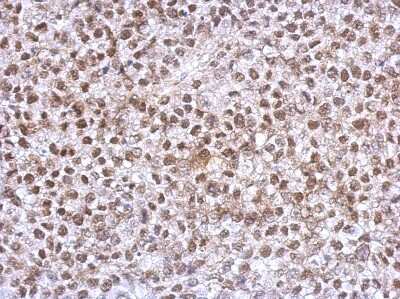 Immunohistochemistry-Paraffin: HOXC10 Antibody [NBP2-16874] - Immunohistochemical analysis of paraffin-embedded Hela xenograft, using antibody at 1:500 dilution.