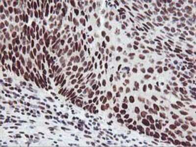 Immunohistochemistry-Paraffin: HOXC11 Antibody (3E10) [NBP2-00499] - Staining of paraffin-embedded Carcinoma of Human bladder tissue using anti-HOXC11 mouse monoclonal antibody.