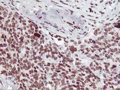 Immunohistochemistry: HOXC11 Antibody (OTI3E10) - Azide and BSA Free [NBP2-70913] - Staining of paraffin-embedded Adenocarcinoma of Human breast tissue using anti-HOXC11 mouse monoclonal antibody.