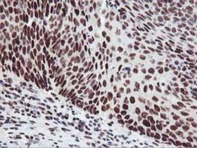 Immunohistochemistry: HOXC11 Antibody (OTI3E10) - Azide and BSA Free [NBP2-70913] - Staining of paraffin-embedded Carcinoma of Human bladder tissue using anti-HOXC11 mouse monoclonal antibody.