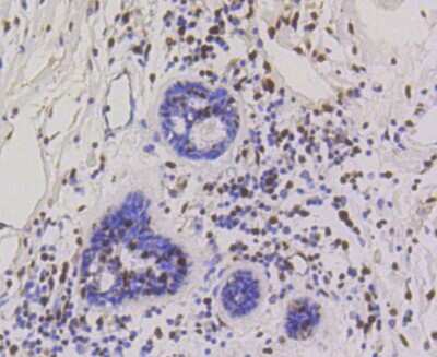 Immunohistochemistry-Paraffin: HP1 alpha Antibody (SR44-03) [NBP2-67349] - Analysis of paraffin-embedded human breast carcinoma tissue using anti-HP1 alpha antibody. Counter stained with hematoxylin.