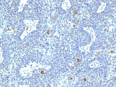 Immunohistochemistry-Paraffin: HPV16 Antibody (HPV16/1295) - Azide and BSA Free [NBP3-08758] - Formalin-fixed, paraffin-embedded human Cervix stained with HPV16 Mouse Monoclonal Antibody (HPV16/1295).