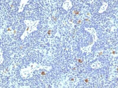 Immunohistochemistry-Paraffin: HPV16 Antibody (HPV16/1295) [NBP3-07844] - Formalin-fixed, paraffin-embedded human Cervix stained with HPV16 Mouse Monoclonal Antibody (HPV16/1295).