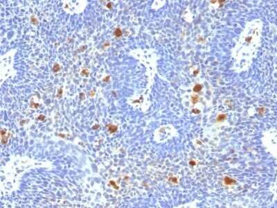 Immunohistochemistry-Paraffin: HPV16 Antibody (HPV16/1296) [NBP2-53374] - Formalin-fixed, paraffin-embedded human Cervix stained with HPV16 Monoclonal Antibody (HPV16/1296)