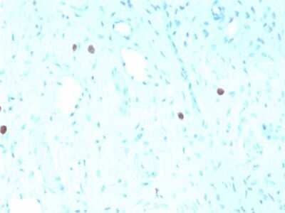 Immunohistochemistry-Paraffin: HPV16 Antibody (rHPV16L1/1058) [NBP3-07259] - Formalin-fixed, paraffin-embedded human Cervix stained with HPV16 Mouse Recombinant Monoclonal Antibody (rHPV16L1/1058).