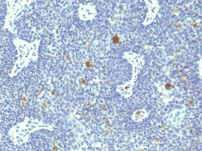 Immunohistochemistry-Paraffin: HPV18 E6 Antibody (HPV18/1297) - Azide and BSA Free [NBP3-08845] - Formalin-fixed, paraffin-embedded human Cervix stained with HPV18 E6 Mouse Monoclonal Antibody (HPV18/1297).