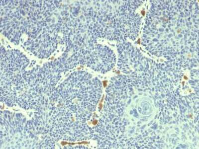 Immunohistochemistry-Paraffin: HPV18 E6 Antibody (HPV18/1297) - Azide and BSA Free [NBP3-08845] - Formalin-fixed, paraffin-embedded human Cervix stained with HPV18 E6 Mouse Monoclonal Antibody (HPV18/1297).