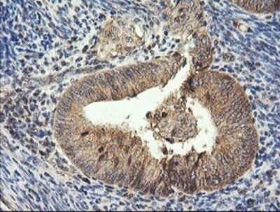 Immunohistochemistry: HRAS Antibody (OTI1D9) - Azide and BSA Free [NBP2-74847] - Analysis of Adenocarcinoma of Human endometrium tissue. (Heat-induced epitope retrieval by 10mM citric buffer, pH6.0, 120C for 3min)