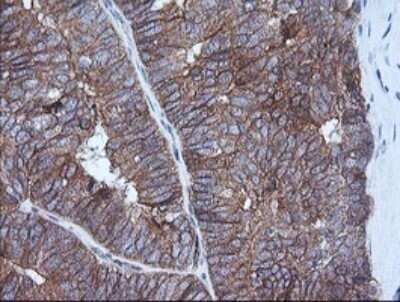 Immunohistochemistry: HRAS Antibody (OTI1D9) - Azide and BSA Free [NBP2-74847] - Analysis of Adenocarcinoma of Human ovary tissue. (Heat-induced epitope retrieval by 10mM citric buffer, pH6.0, 120C for 3min)