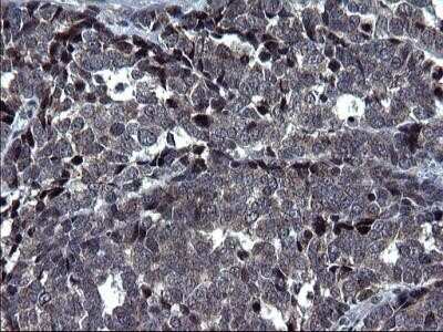Immunohistochemistry: HSCB Antibody (OTI3E1) - Azide and BSA Free [NBP2-72415] - Analysis of Adenocarcinoma of Human colon tissue. (Heat-induced epitope retrieval by 1 mM EDTA in 10mM Tris, pH8.5, 120C for 3min)