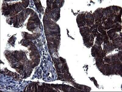 Immunohistochemistry: HSCB Antibody (OTI3E1) - Azide and BSA Free [NBP2-72415] - Analysis of Adenocarcinoma of Human endometrium tissue. (Heat-induced epitope retrieval by 1 mM EDTA in 10mM Tris, pH8.5, 120C for 3min)