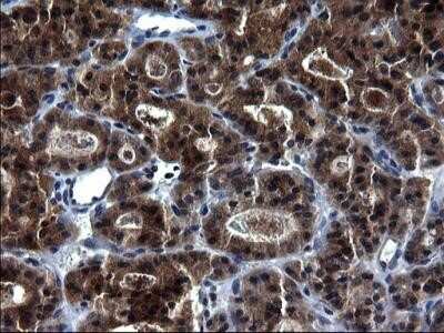 Immunohistochemistry: HSCB Antibody (OTI3E1) - Azide and BSA Free [NBP2-72415] - Analysis of Carcinoma of Human thyroid tissue. (Heat-induced epitope retrieval by 1 mM EDTA in 10mM Tris, pH8.5, 120C for 3min)