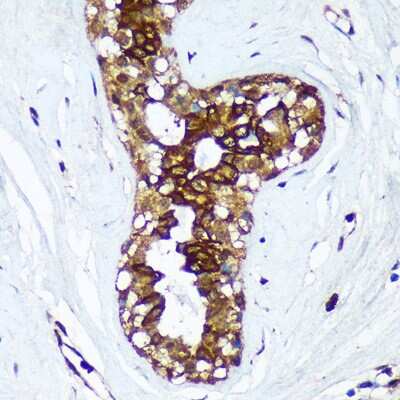 Immunohistochemistry-Paraffin: HSD17B7 Antibody [NBP3-15527] - Immunohistochemistry of paraffin-embedded Human breast cancer using HSD17B7 Rabbit pAb (NBP3-15527) at dilution of 1:100 (40x lens).Perform microwave antigen retrieval with 10 mM Tris/EDTA buffer pH 9.0 before commencing with IHC staining protocol.