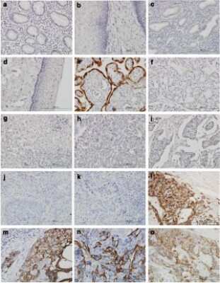 Immunohistochemistry-Paraffin: HSD3B1 Antibody (3C11-D4) [H00003283-M01] - Immunohistochemical staining of various tissues with hematoxylin and HSD3B1 antibody under high magnification.Antibody concentration 3 ug/ml. ( a ) Stomach ( b ) Esophagus ( c ) Endometrium ( d ) Uterine cervix ( e ) Placenta ( f ) Ovary, clear cell carcinoma ( g ) Hepatocellular carcinoma ( h ) Breast cancer ( i ) Colon adenocarcinoma  ( j and k ) Cervical carcinoma ( l, m, and n ) Choriocarcinoma ( o ) Epithelioid trophoblastic tumor.