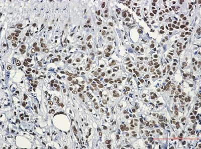 Immunohistochemistry-Paraffin: HSF1 Antibody (S07-0G0) [NBP3-14895] - Immunohistochemistry of HSF1 in paraffin-embedded Human breast cancer tissue using HSF1 Rabbit mAb at dilution 1/50