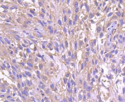 Immunohistochemistry-Paraffin: HSF1 [p Ser326] Antibody (SU31-03) [NBP2-67455] - Analysis of paraffin-embedded human breast carcinoma tissue using anti-p-HSF1(S326) antibody. Counter stained with hematoxylin.