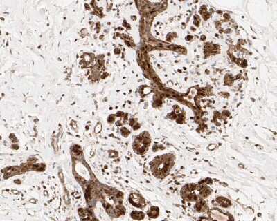 Immunohistochemistry-Paraffin: HSF1 [p Ser326] Antibody (SU31-03) [NBP2-67455] - Immunohistochemical analysis of paraffin-embedded human breast tissue using anti-HSF1 antibody. The section was pre-treated using heat mediated antigen retrieval with sodium citrate buffer (pH 6.0) for 20 minutes. The tissues were blocked in 5% BSA for 30 minutes at room temperature, washed with ddH2O and PBS, and then probed with the primary antibody (ET1608-11, 1/50) for 30 minutes at room temperature. The detection was performed using an HRP conjugated compact polymer system. DAB was used as the chromogen. Tissues were counterstained with hematoxylin and mounted with DPX.