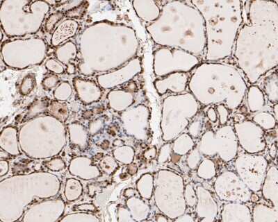 Immunohistochemistry-Paraffin: HSF1 [p Ser326] Antibody (SU31-03) [NBP2-67455] - Immunohistochemical analysis of paraffin-embedded human thyroid tissue using anti-HSF1 antibody. The section was pre-treated using heat mediated antigen retrieval with sodium citrate buffer (pH 6.0) for 20 minutes. The tissues were blocked in 5% BSA for 30 minutes at room temperature, washed with ddH2O and PBS, and then probed with the primary antibody (ET1608-11, 1/50) for 30 minutes at room temperature. The detection was performed using an HRP conjugated compact polymer system. DAB was used as the chromogen. Tissues were counterstained with hematoxylin and mounted with DPX.