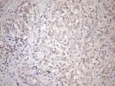 Immunohistochemistry: HSF2 Antibody (OTI3E1) - Azide and BSA Free [NBP2-70948] - Analysis of Adenocarcinoma of Human endometrium tissue. (Heat-induced epitope retrieval by 1mM EDTA in 10mM Tris buffer (pH8.5) at 120C for 3 min)