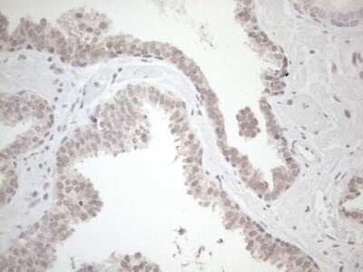 Immunohistochemistry: HSF2 Antibody (OTI3E1) - Azide and BSA Free [NBP2-70948] - Analysis of Carcinoma of Human prostate tissue. (Heat-induced epitope retrieval by 1mM EDTA in 10mM Tris buffer (pH8.5) at 120C for 3 min)