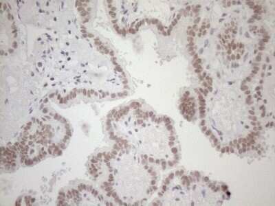 Immunohistochemistry: HSF2 Antibody (OTI3E1) - Azide and BSA Free [NBP2-70948] - Analysis of Carcinoma of Human thyroid tissue. (Heat-induced epitope retrieval by 1mM EDTA in 10mM Tris buffer (pH8.5) at 120C for 3 min)