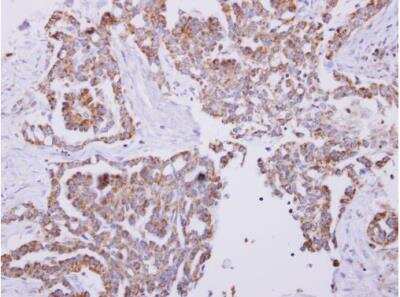 Immunohistochemistry-Paraffin: HSP10/EPF Antibody [NBP2-16890] - Lung carcinoma. Cpn10 antibody dilution: 1:250. Antigen Retrieval: Trilogy™ (EDTA based, pH 8.0) buffer, 15min.