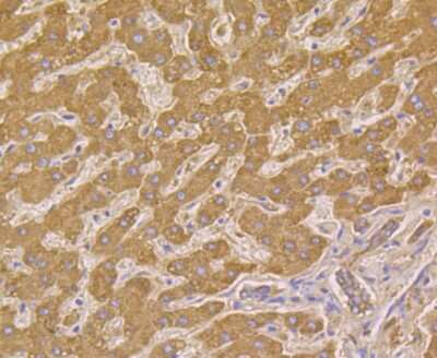 Immunohistochemistry-Paraffin: HSP10/EPF Antibody (JG82-34) [NBP2-75529] - Analysis of paraffin-embedded human liver cancer tissue using anti-Cpn10 antibody. Counter stained with hematoxylin.