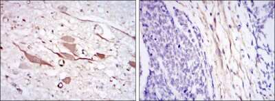 Immunohistochemistry: HSP27 Antibody (5D7) [NBP2-37599] - Immunohistochemical analysis of paraffin-embedded brain tissues (left) and esophageal cancer tissues (right) using HSP27 mouse mAb with DAB staining.